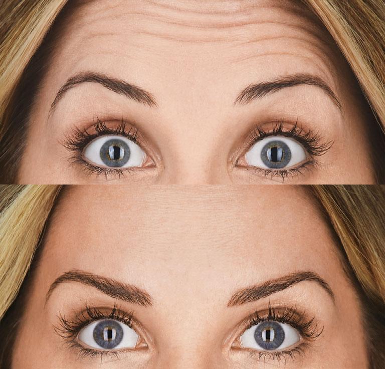 The-Look-of-3-from-BOTOX-Cosmetic--Debbie-B&A-1